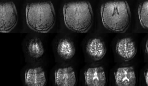 Tyger - portable MRI story: MRI scans